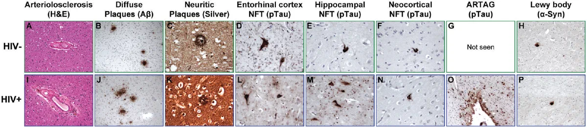 Histopathology panels comparing arteriolosclerosis, plaques, tau and Lewy body pathology in HIV-negative and HIV-positive brains.